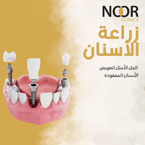 زراعة الأسنان: الحل الأمثل لتعويض الأسنان المفقودة